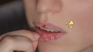 bibir pecah-pecah